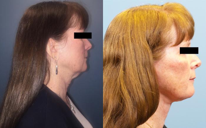 Before & After Neck Lift/ Lower Facelift Case 106 View #3 View in Portland, OR