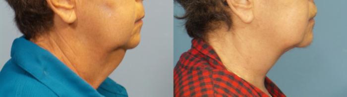 Before & After Neck Lift/ Lower Facelift Case 398 Right Side View in Portland, OR