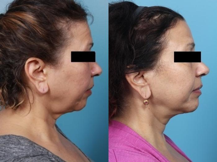Before & After Neck Lift/ Lower Facelift Case 42 View #1 View in Portland, OR
