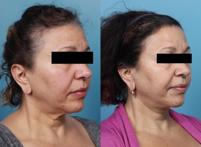 Before & After Neck Lift/ Lower Facelift Case 42 View #2 View in Portland, OR