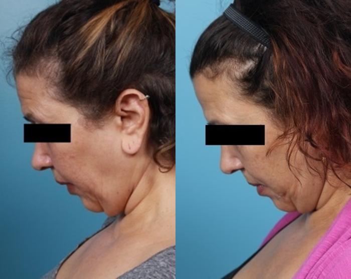 Before & After Neck Lift/ Lower Facelift Case 42 View #3 View in Portland, OR