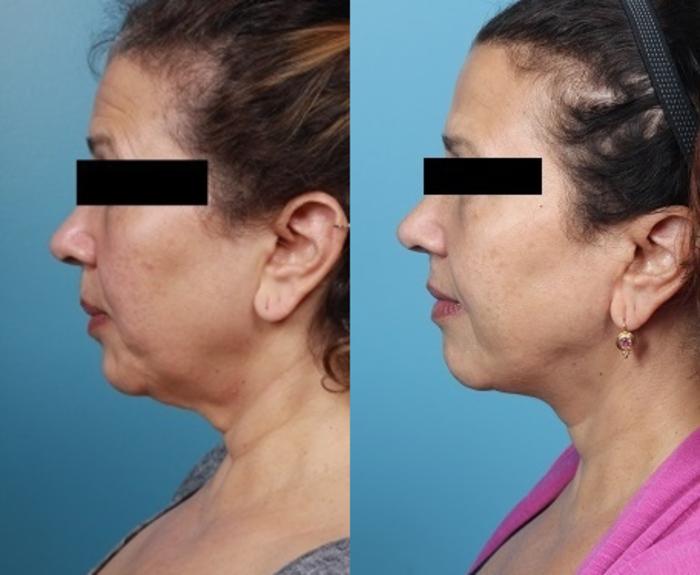 Before & After Neck Lift/ Lower Facelift Case 42 View #4 View in Portland, OR