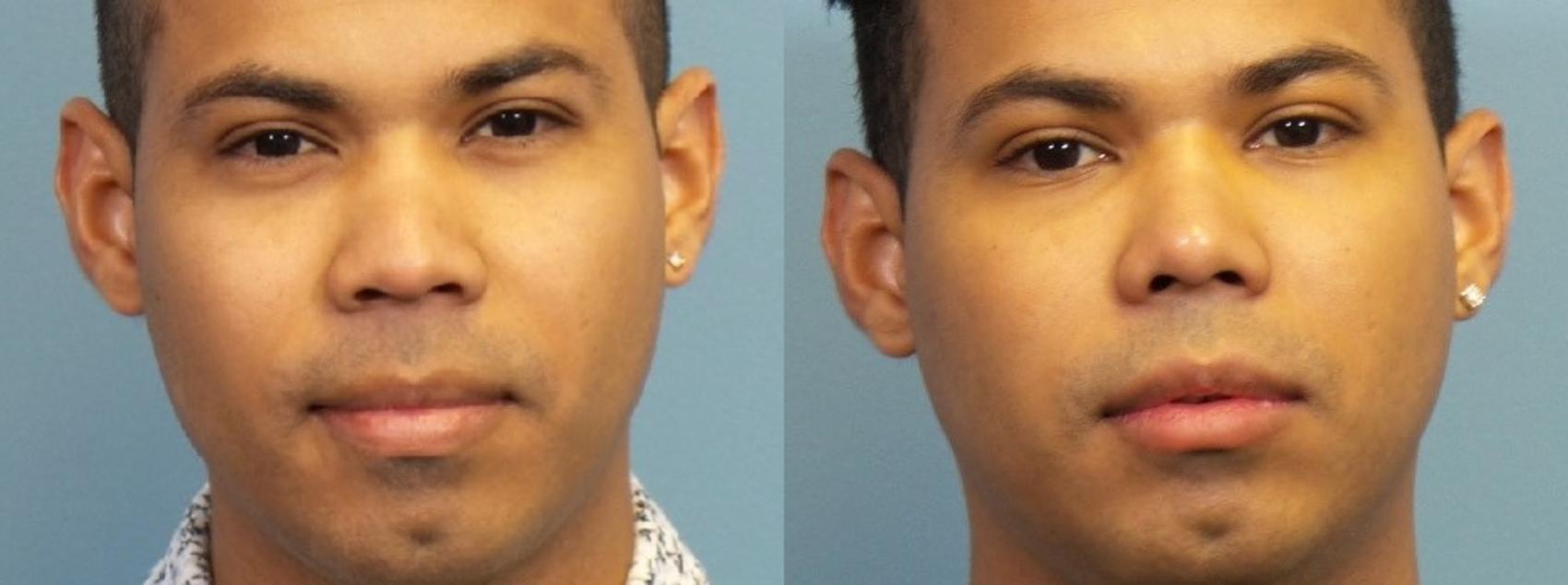 Before & After Rhinoplasty Case 263 View #1 View in Portland, OR