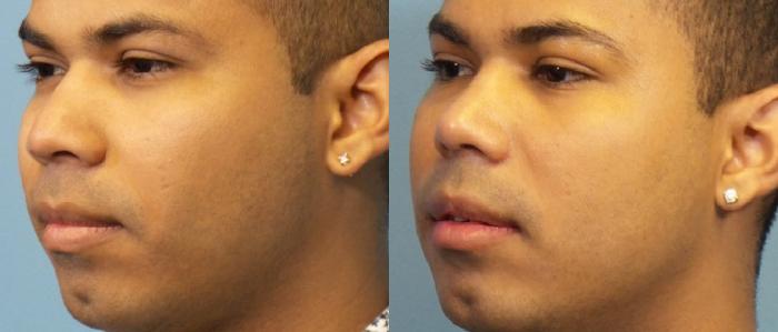 Before & After Rhinoplasty Case 263 View #2 View in Portland, OR