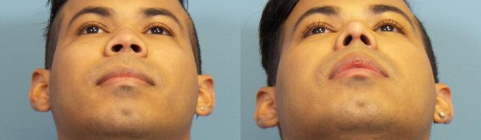 Before & After Rhinoplasty Case 263 View #3 View in Portland, OR