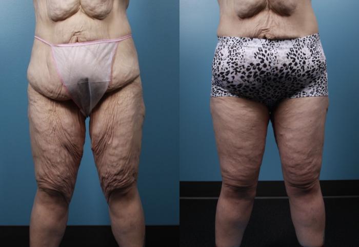 Before & After Thigh Lift Case 107 View #3 View in Portland, OR