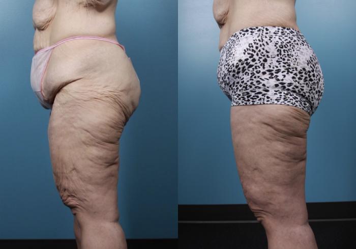 Before & After Massive Weight Loss/Body Lift Case 107 View #4 View in Portland, OR