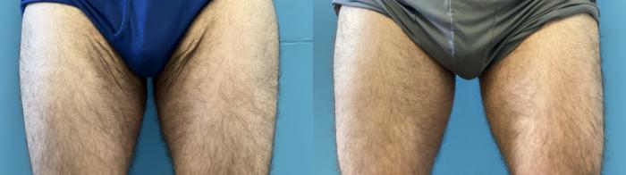 Before & After Thigh Lift Case 339 Front View in Portland, OR
