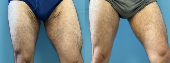 Before & After Thigh Lift Case 339 Left Oblique View in Portland, OR
