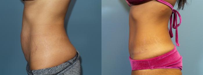 Before & After Tummy Tuck (Abdominoplasty) Case 113 View #1 View in Portland, OR