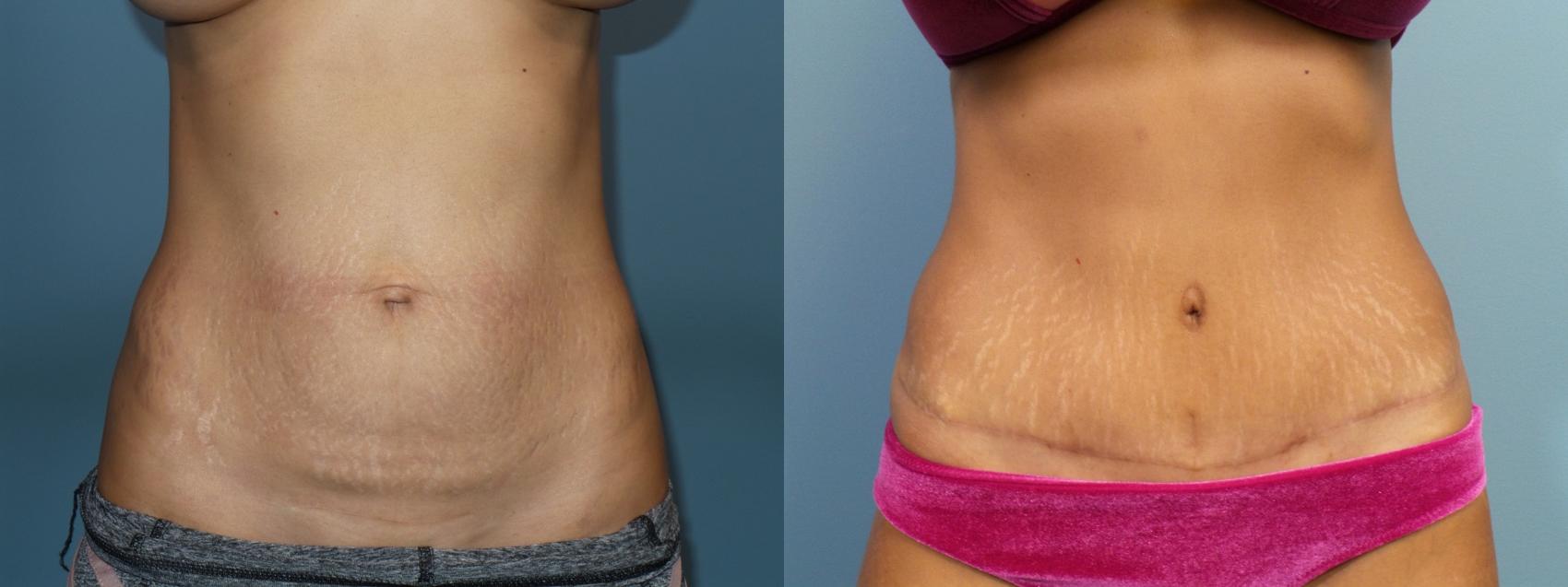 Before & After Tummy Tuck (Abdominoplasty) Case 113 View #2 View in Portland, OR