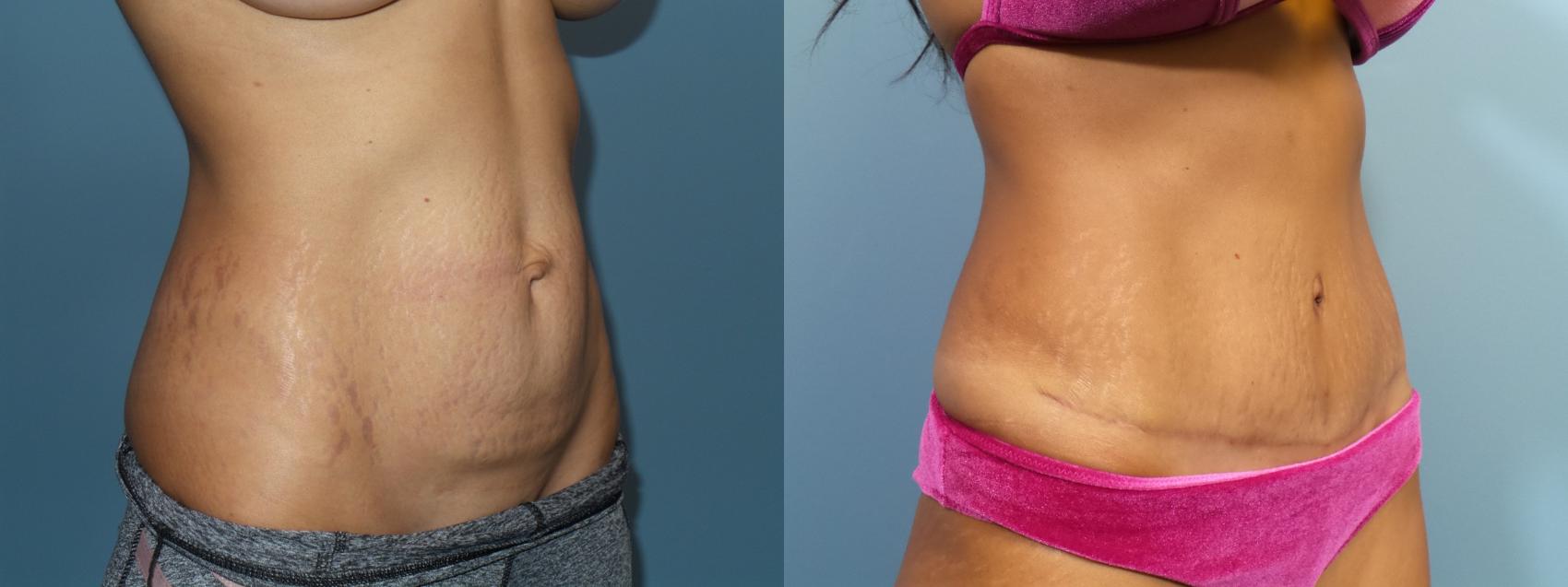 Before & After Tummy Tuck (Abdominoplasty) Case 113 View #3 View in Portland, OR