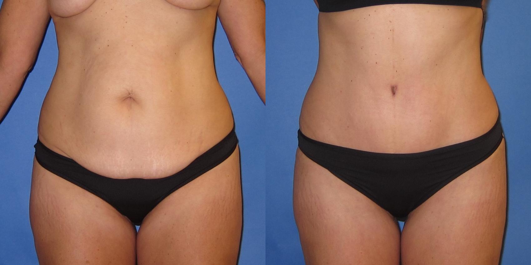 Before & After Tummy Tuck (Abdominoplasty) Case 252 View #1 View in Portland, OR