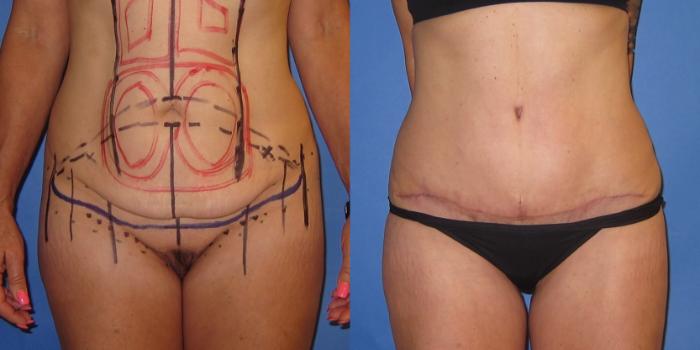 Before & After Tummy Tuck (Abdominoplasty) Case 252 View #2 View in Portland, OR