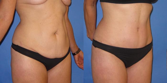 Before & After Tummy Tuck (Abdominoplasty) Case 252 View #3 View in Portland, OR