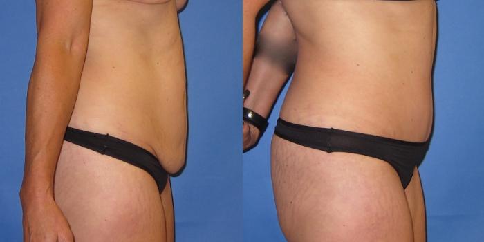 Before & After Tummy Tuck (Abdominoplasty) Case 252 View #4 View in Portland, OR