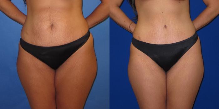 Before & After Tummy Tuck (Abdominoplasty) Case 253 View #1 View in Portland, OR