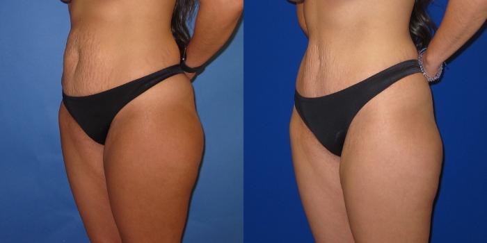 Before & After Tummy Tuck (Abdominoplasty) Case 253 View #2 View in Portland, OR