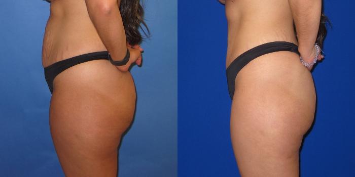 Before & After Tummy Tuck (Abdominoplasty) Case 253 View #3 View in Portland, OR