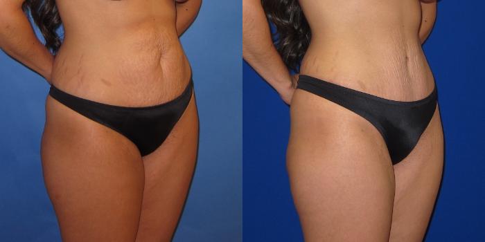 Before & After Tummy Tuck (Abdominoplasty) Case 253 View #4 View in Portland, OR