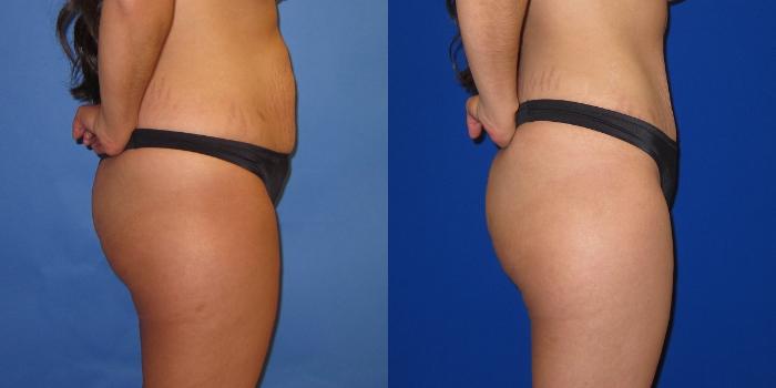 Before & After Tummy Tuck (Abdominoplasty) Case 253 View #5 View in Portland, OR