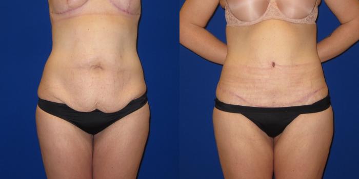 Liposuction Creates A Waist For Tummy Tuck Patients Case #206