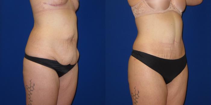 Before & After Tummy Tuck (Abdominoplasty) Case 254 View #2 View in Portland, OR