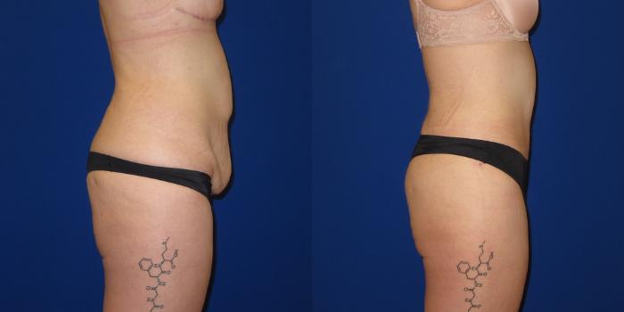 Before & After Massive Weight Loss/Body Lift Case 254 View #3 View in Portland, OR