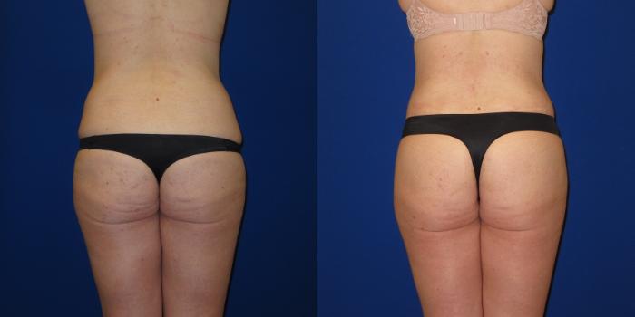 Before & After Tummy Tuck (Abdominoplasty) Case 254 View #4 View in Portland, OR