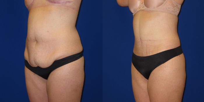 Before & After Tummy Tuck (Abdominoplasty) Case 254 View #5 View in Portland, OR