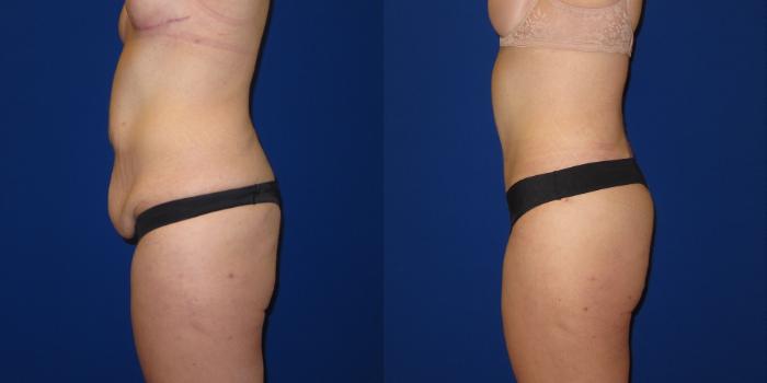 Before & After Tummy Tuck (Abdominoplasty) Case 254 View #6 View in Portland, OR