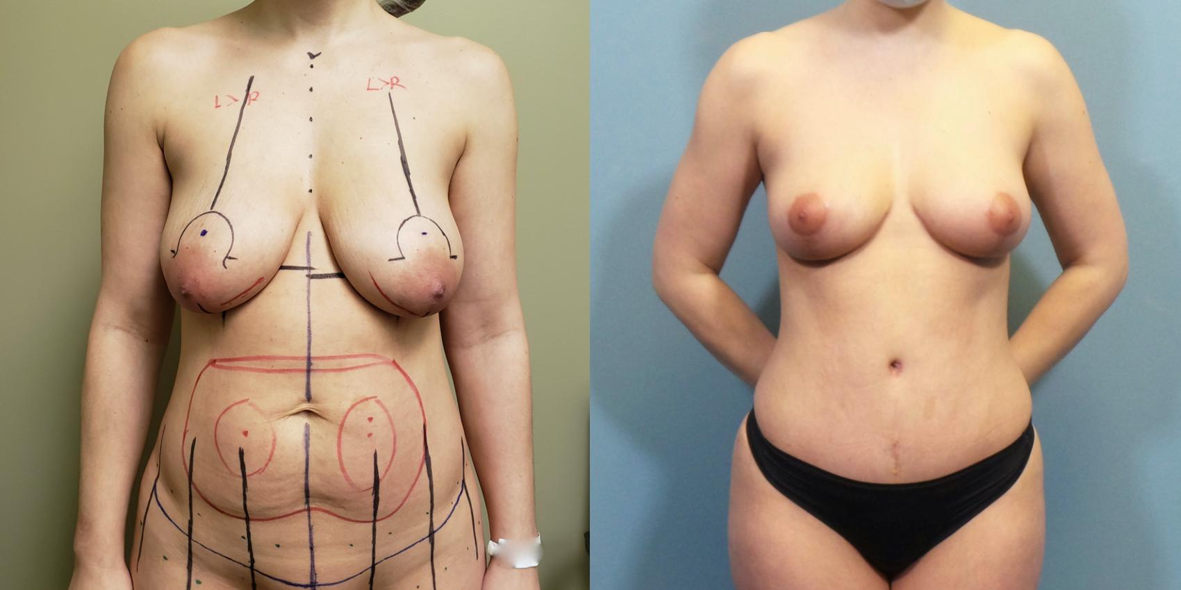 Before & After Breast Lift Case 258 View #1 View in Portland, OR