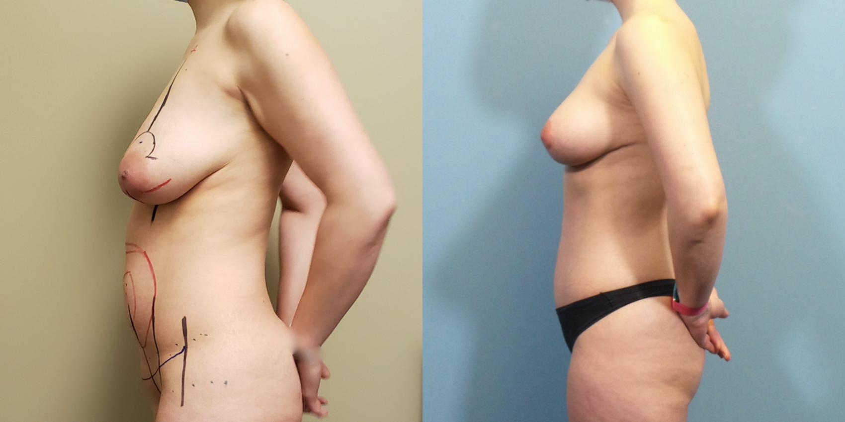 Before & After Breast Lift Case 258 View #2 View in Portland, OR