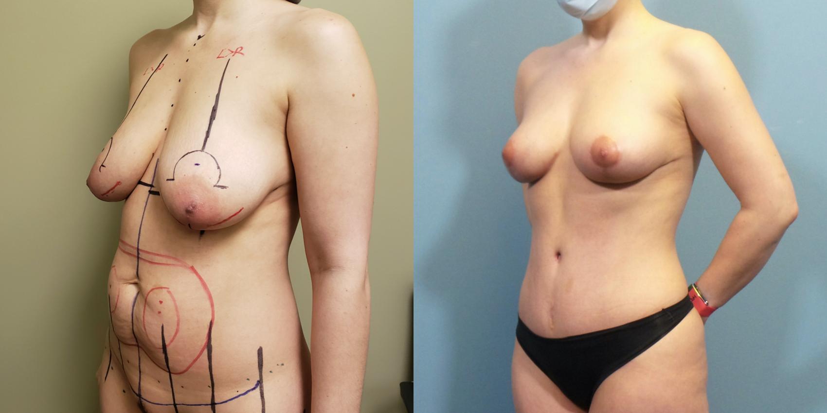 Before & After Breast Lift Case 258 View #3 View in Portland, OR