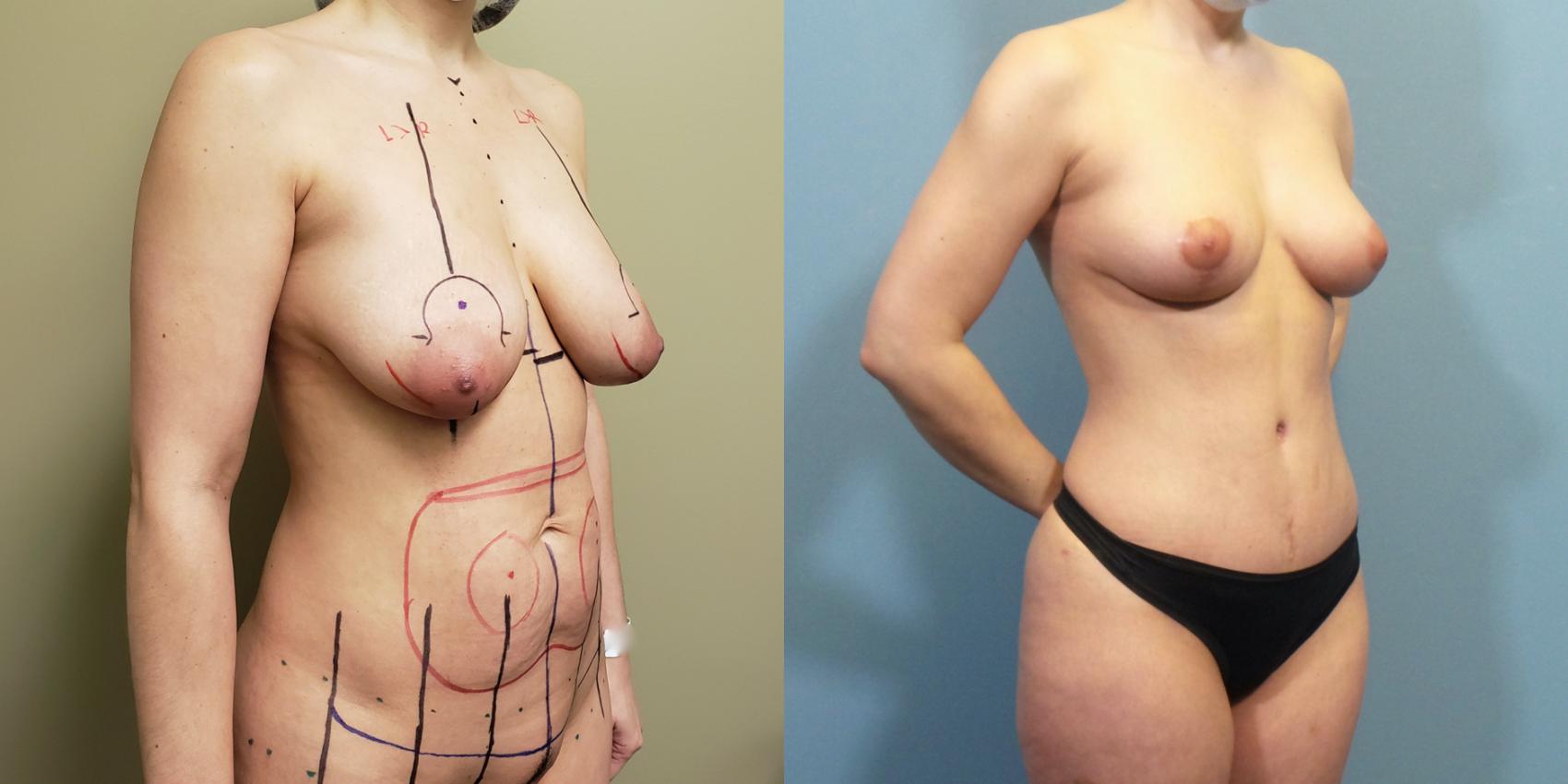 Before & After Breast Lift Case 258 View #4 View in Portland, OR
