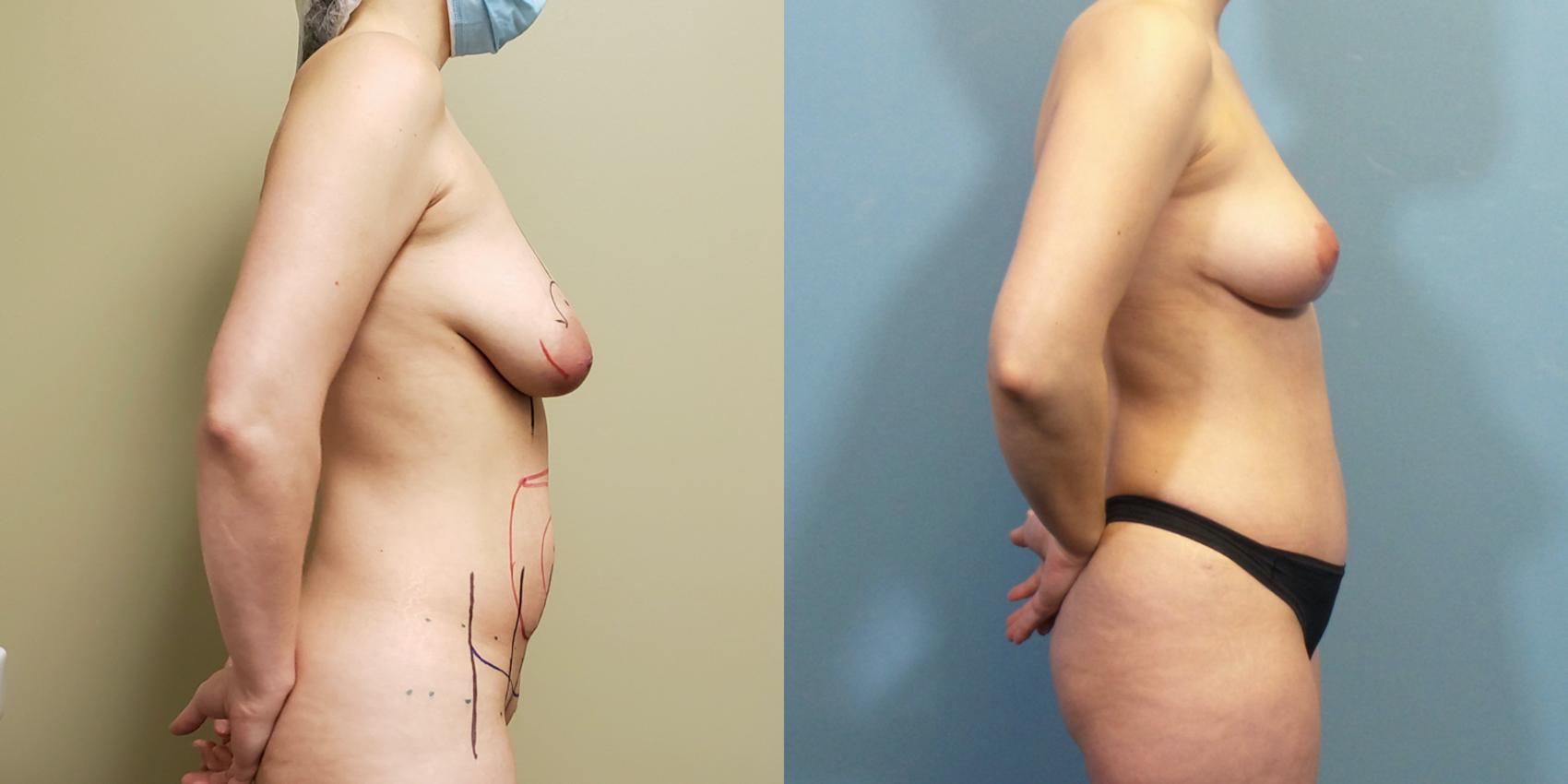 Before & After Tummy Tuck (Abdominoplasty) Case 258 View #5 View in Portland, OR