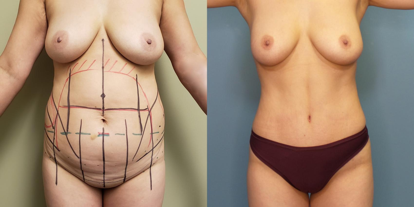 Tummy Tuck (Abdominoplasty) Before and After Pictures Case 267