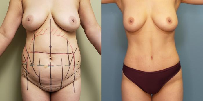 Before & After Tummy Tuck (Abdominoplasty) Case 267 Front View in Portland, OR