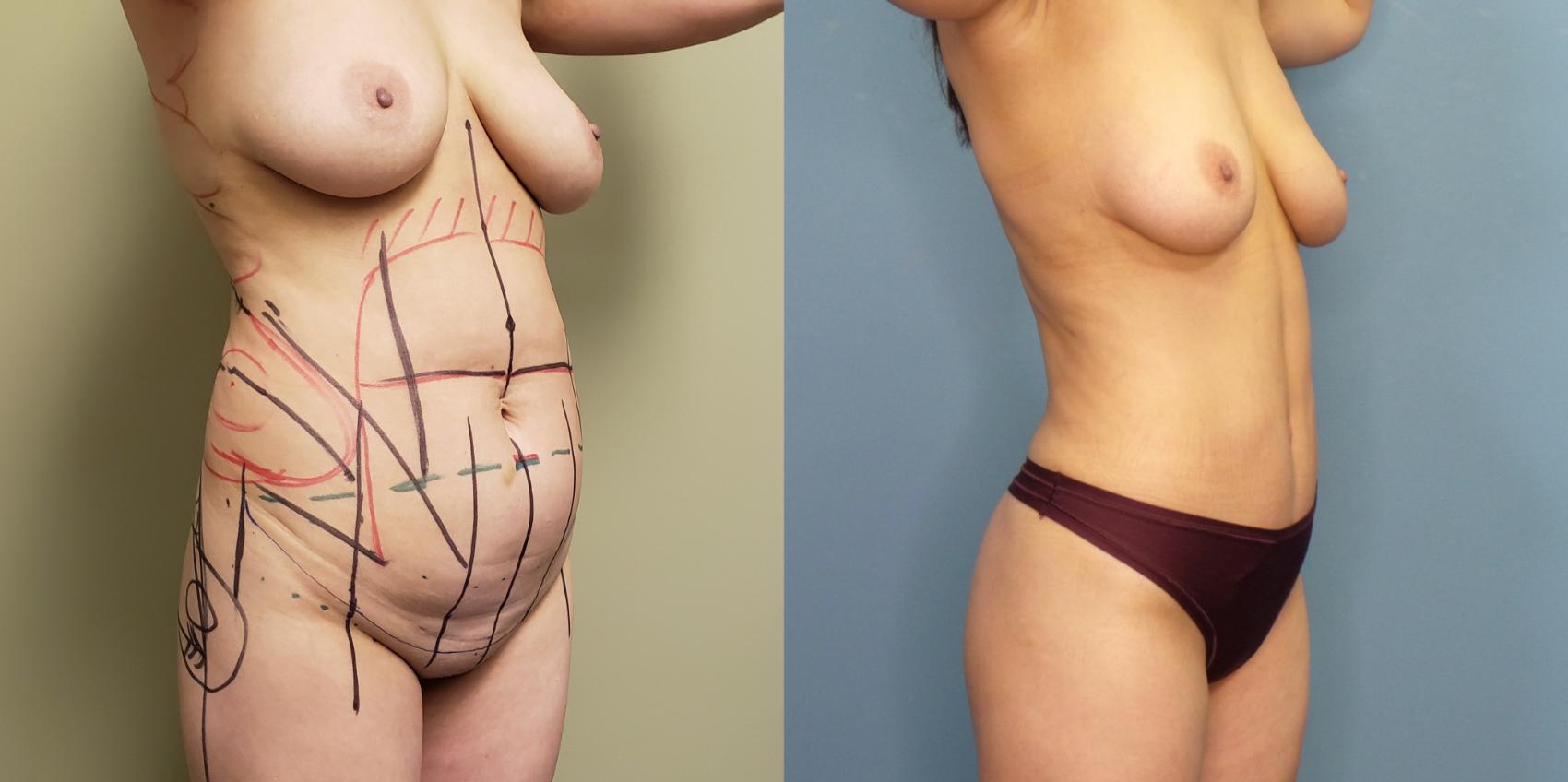 Before & After Tummy Tuck (Abdominoplasty) Case 267 Right Oblique View in Portland, OR