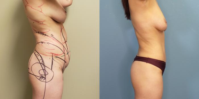 Before & After Tummy Tuck (Abdominoplasty) Case 267 Right Side View in Portland, OR