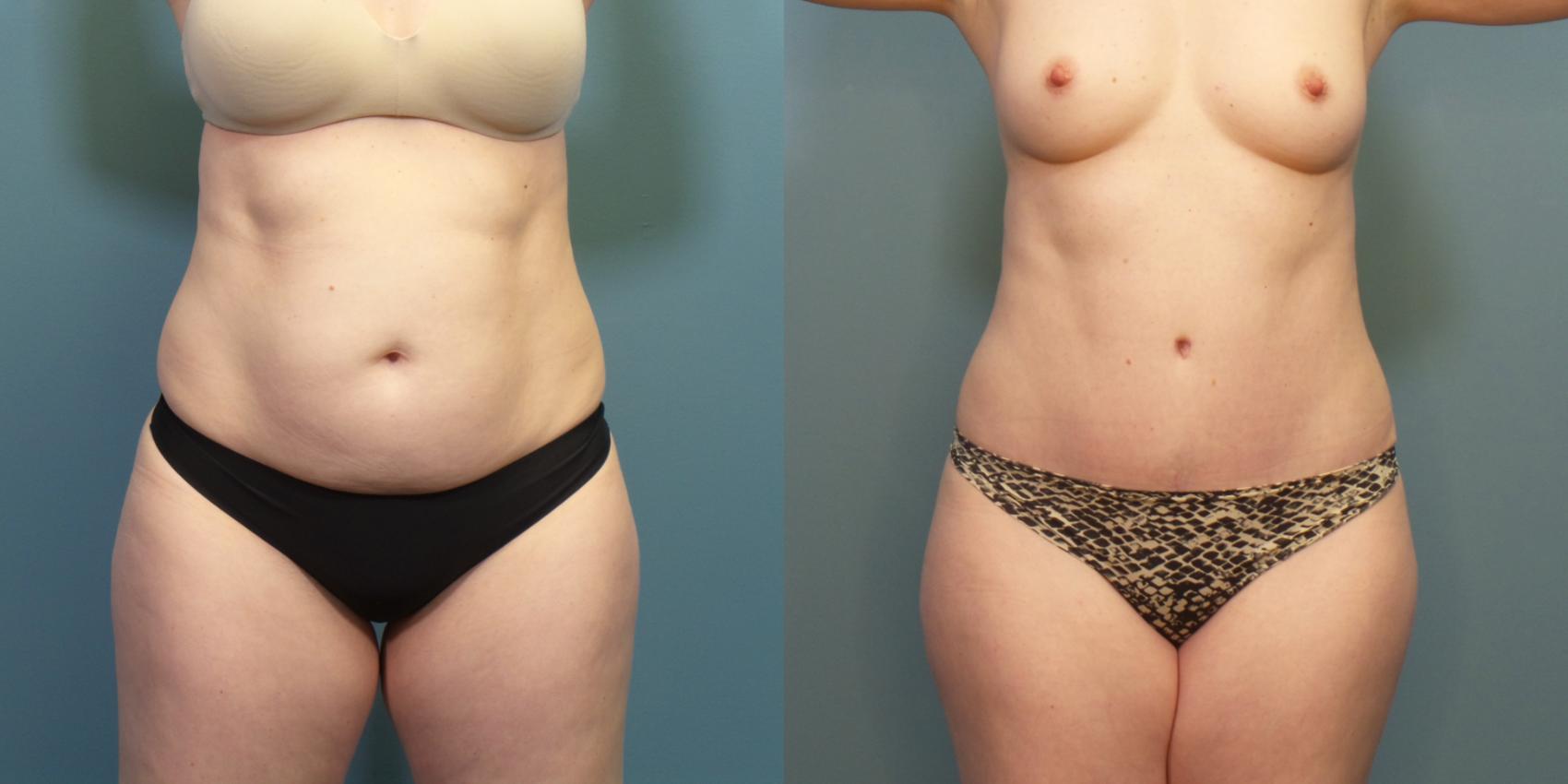 Before & After Tummy Tuck (Abdominoplasty) Case 276 Front View in Portland, OR