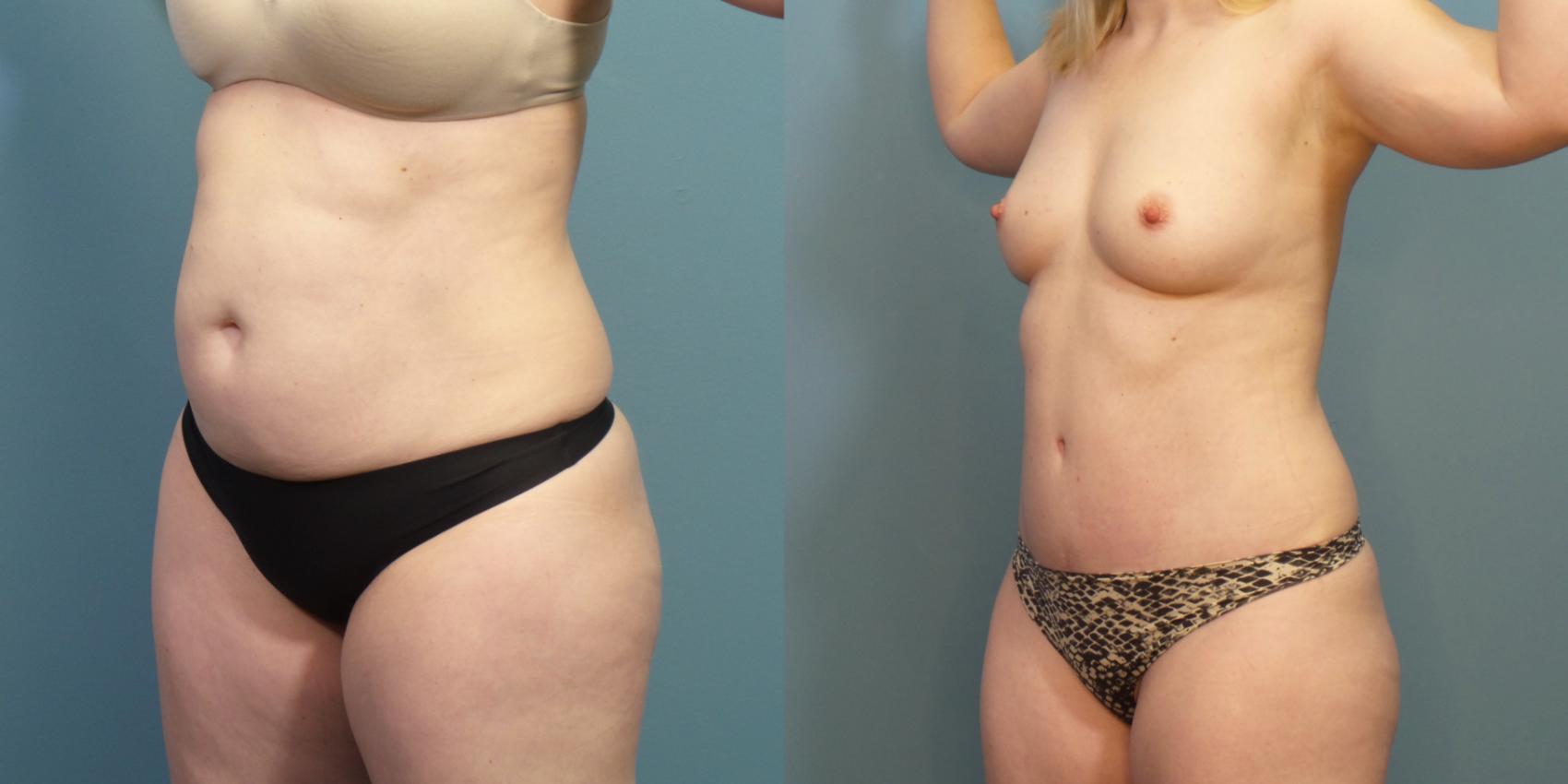 Before & After Tummy Tuck (Abdominoplasty) Case 276 Left Oblique View in Portland, OR