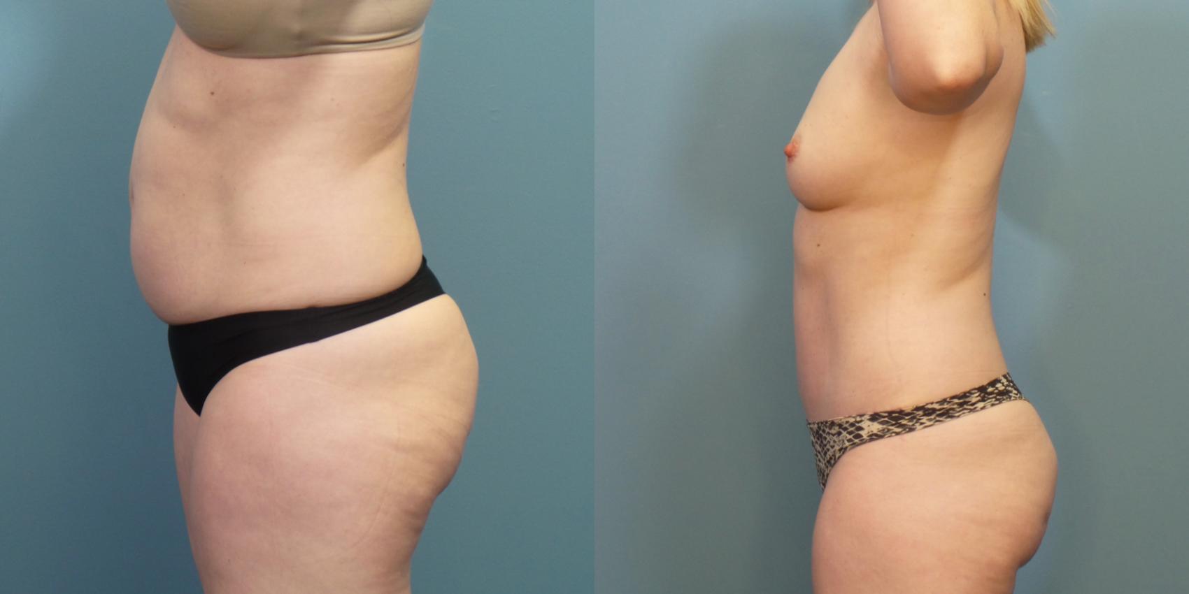 Before & After Tummy Tuck (Abdominoplasty) Case 276 Left Side View in Portland, OR