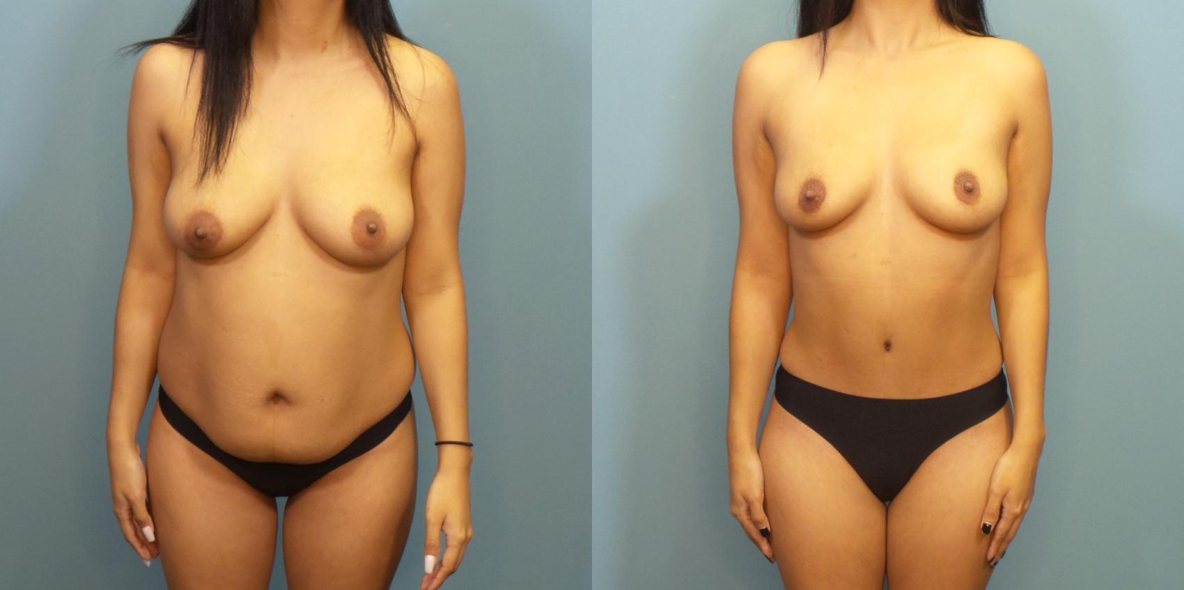 Before & After Tummy Tuck (Abdominoplasty) Case 280 Front View in Portland, OR