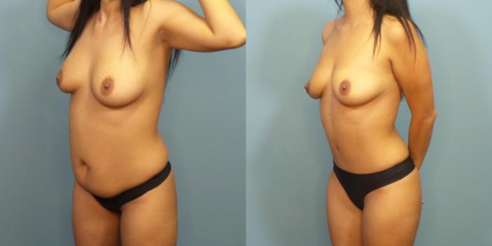 Before & After Tummy Tuck (Abdominoplasty) Case 280 Left Oblique View in Portland, OR