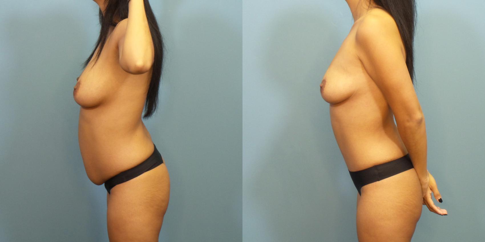 Before & After Tummy Tuck (Abdominoplasty) Case 280 Left Side View in Portland, OR