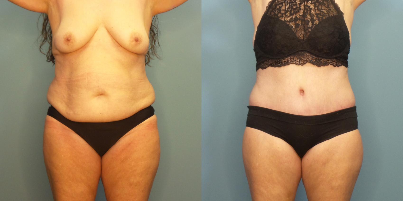 Before & After Massive Weight Loss/Body Lift Case 283 Front View in Portland, OR