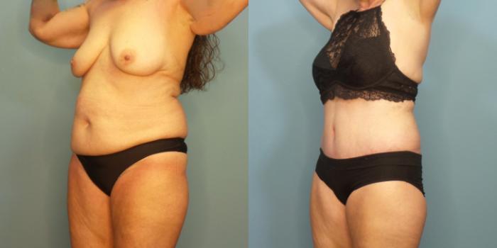 Before & After Tummy Tuck (Abdominoplasty) Case 283 Left Oblique View in Portland, OR