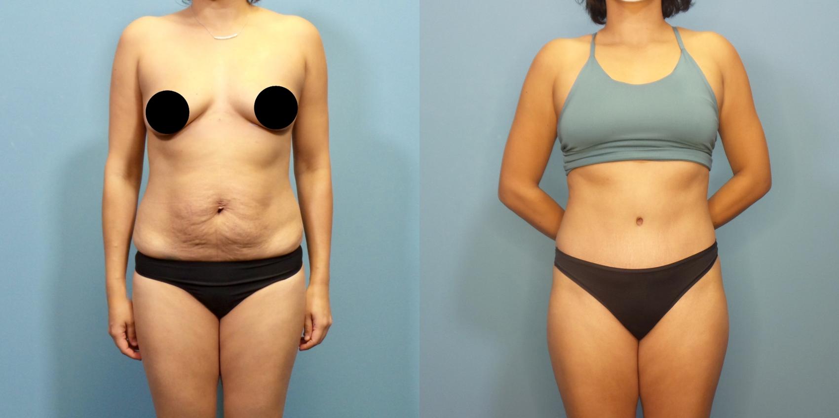 Before & After Tummy Tuck (Abdominoplasty) Case 284 Front View in Portland, OR