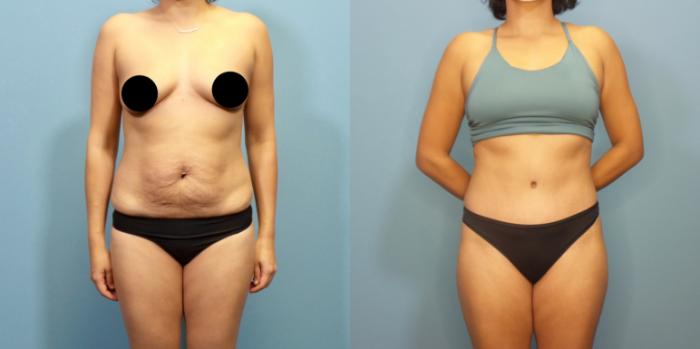 Before & After Liposuction Case 284 Front View in Portland, OR